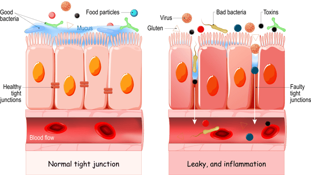 Leaky Gut Illistration