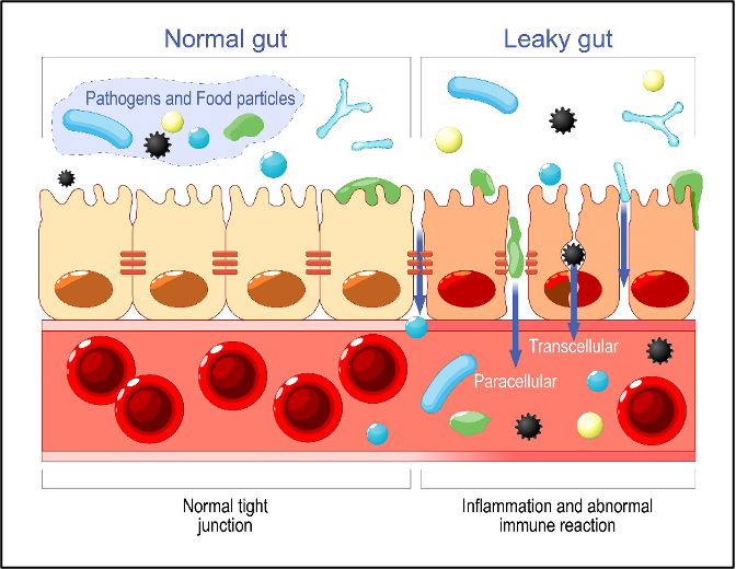 Normal vs Leaky Gut