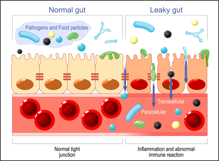 Diagram of Normal Gut vs. Leaky Gut